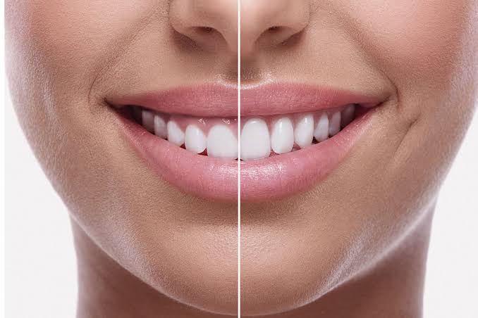 Comparação de sorriso antes e depois da gengivoplastia, mostrando a linha do sorriso dividida ao meio, de um lado com mais gengiva aparente e do outro com dentes mais proporcionais e contorno gengival simétrico, fotografia macro close-up da boca e sorriso, tons rosados e brancos, iluminação suave e nítida